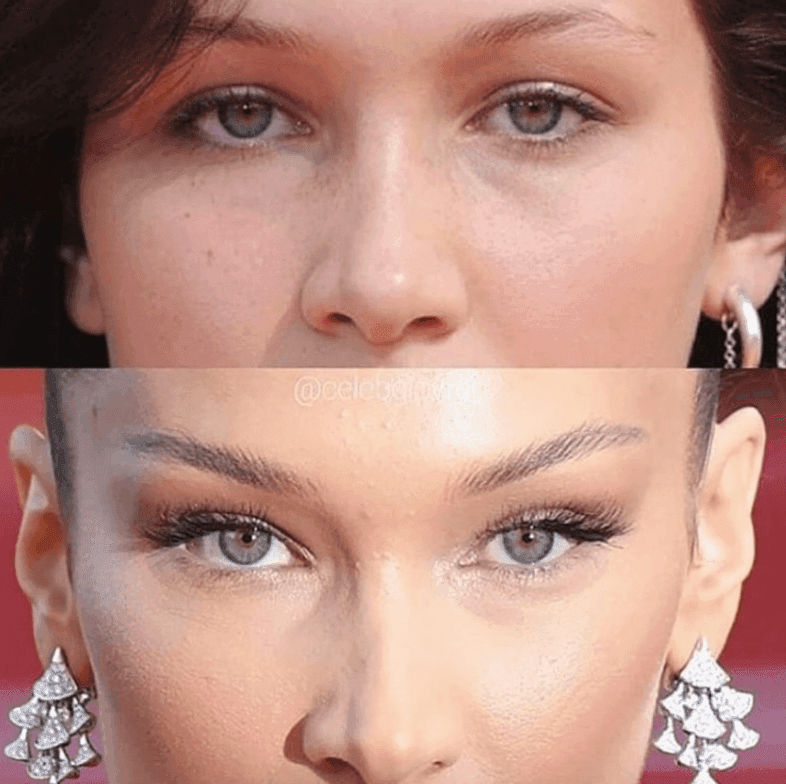 Can Botox Give You a Brow Lift?